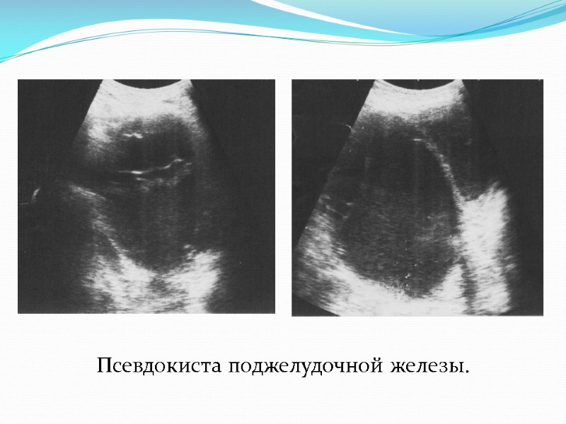 Псевдокиста поджелудочной железы.
